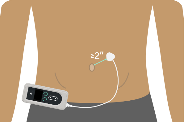 Insert the cannula greater than or equal to 2 inches away from the navel.