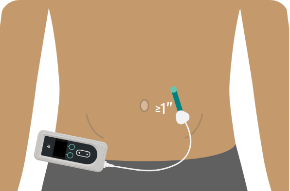 Insert the cannula greater than or equal to 1 inch away from previous infusion site.