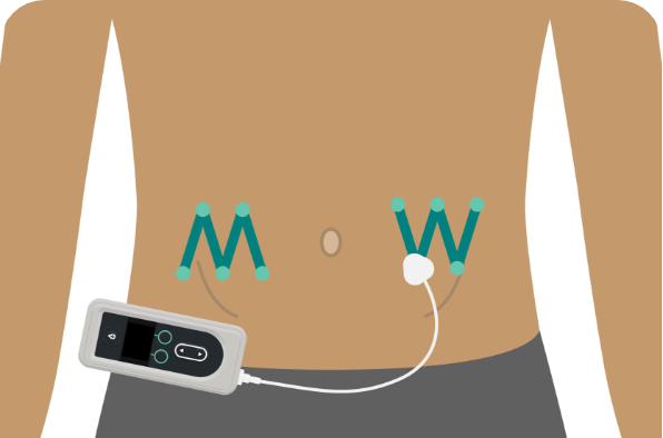 Insert the cannula in different infusion site spots that follow a similar pattern.